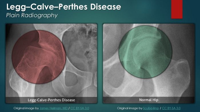 Legg-Calvé-Perthes