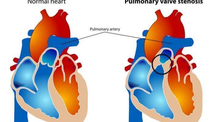 Estenosis pulmonar
